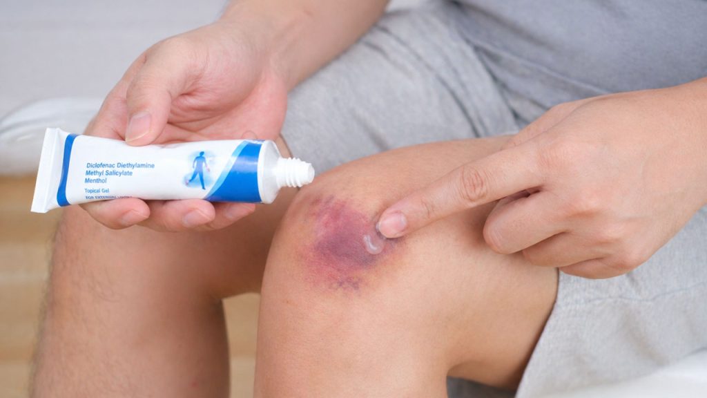 Bôi gel giúp giảm sưng bầm tím nhanh sau va đập