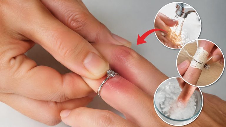 Mẹo lấy nhẫn chật ra khỏi tay bằng cách dùng xà phòng, chỉ và nước lạnh