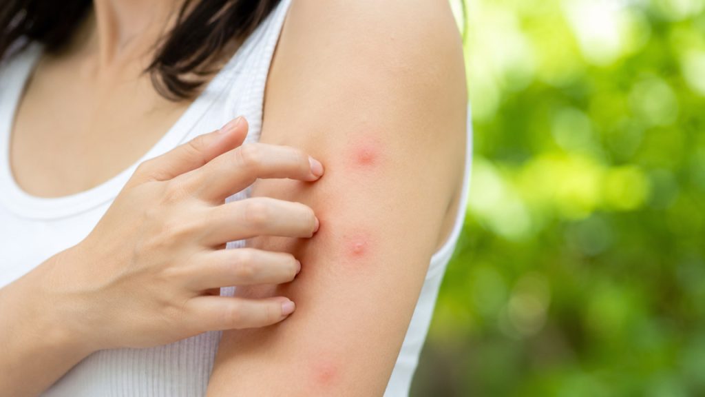 9 Mẹo Làm Dịu Vết Côn Trùng Cắn Hiệu Quả Tại Nhà