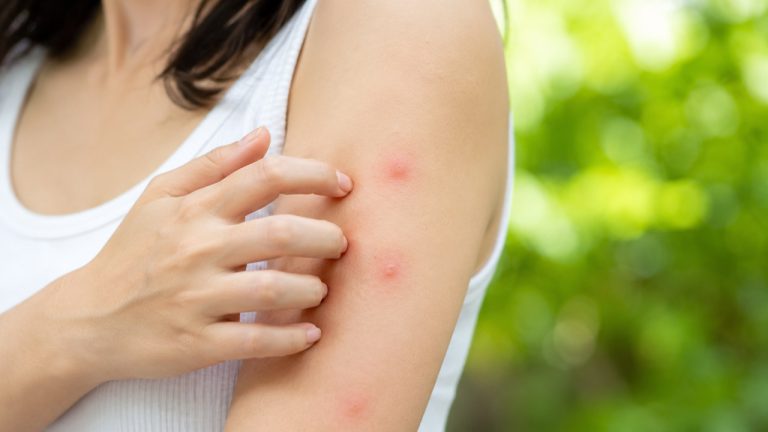 Mẹo làm dịu vết côn trùng cắn bằng cách thoa dầu lên vùng da bị nổi mẩn đỏ