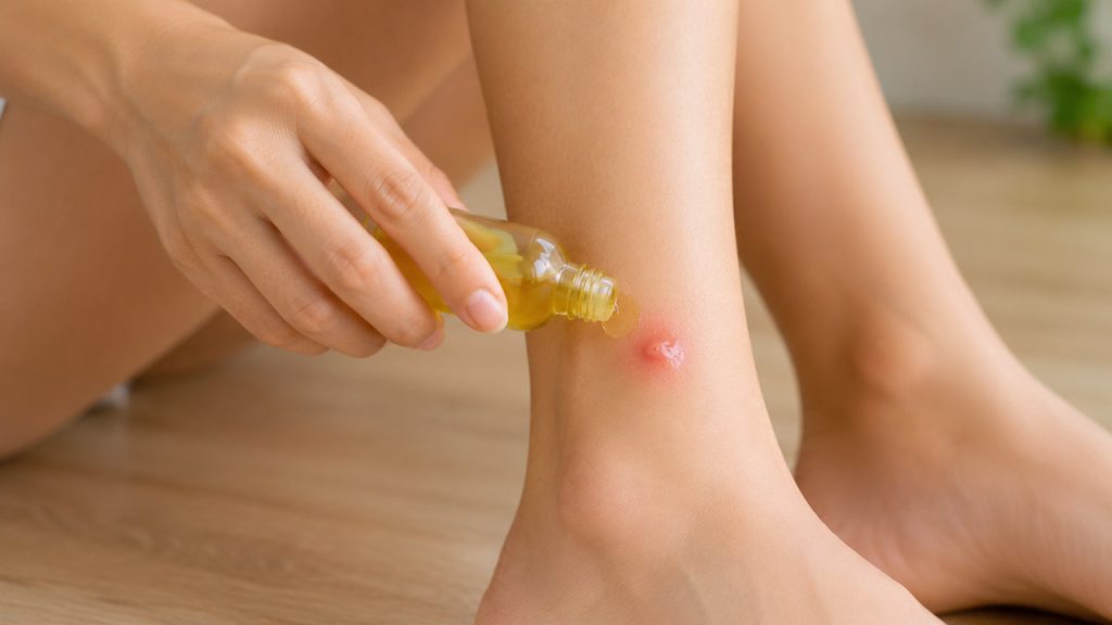 Thoa dầu lên vết côn trùng cắn dưới chân để giảm ngứa và khó chịu