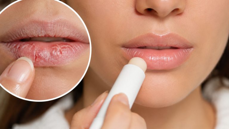 10 Cách Khắc Phục Môi Khô Nứt Do Thời Tiết Hanh Khô Hiệu Quả