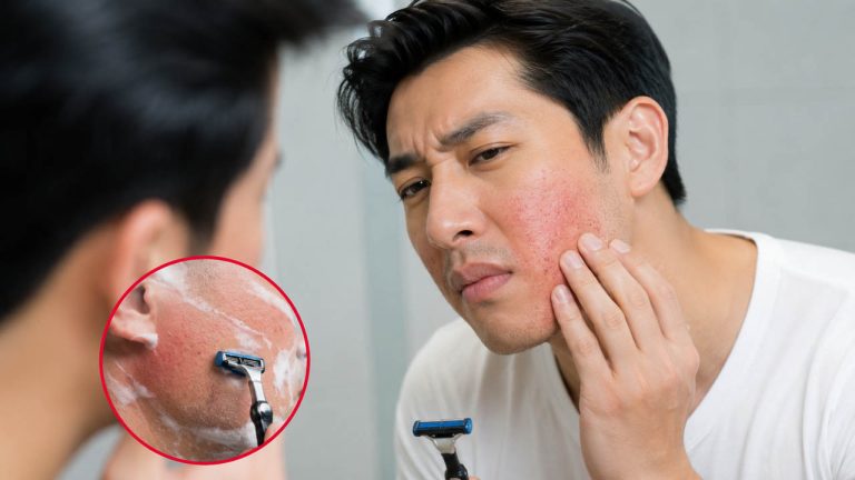 Mẹo làm dịu da bị rát sau khi cạo râu hiệu quả tại nhà