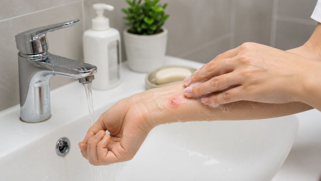 Rửa sạch vùng da bị muỗi đốt bằng nước và xà phòng dịu nhẹ