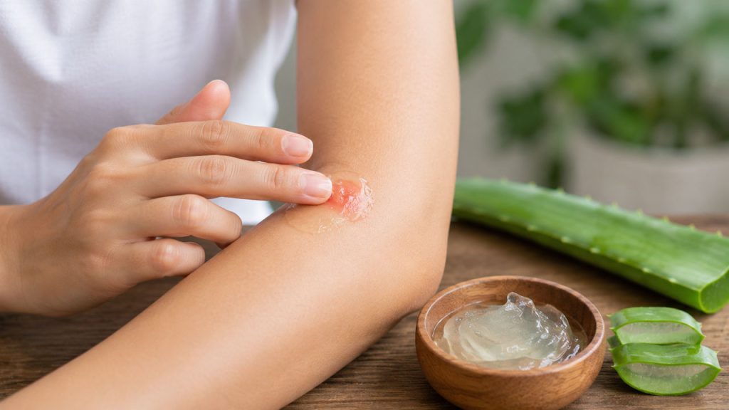 Thoa gel nha đam giúp làm dịu da khi bị muỗi đốt