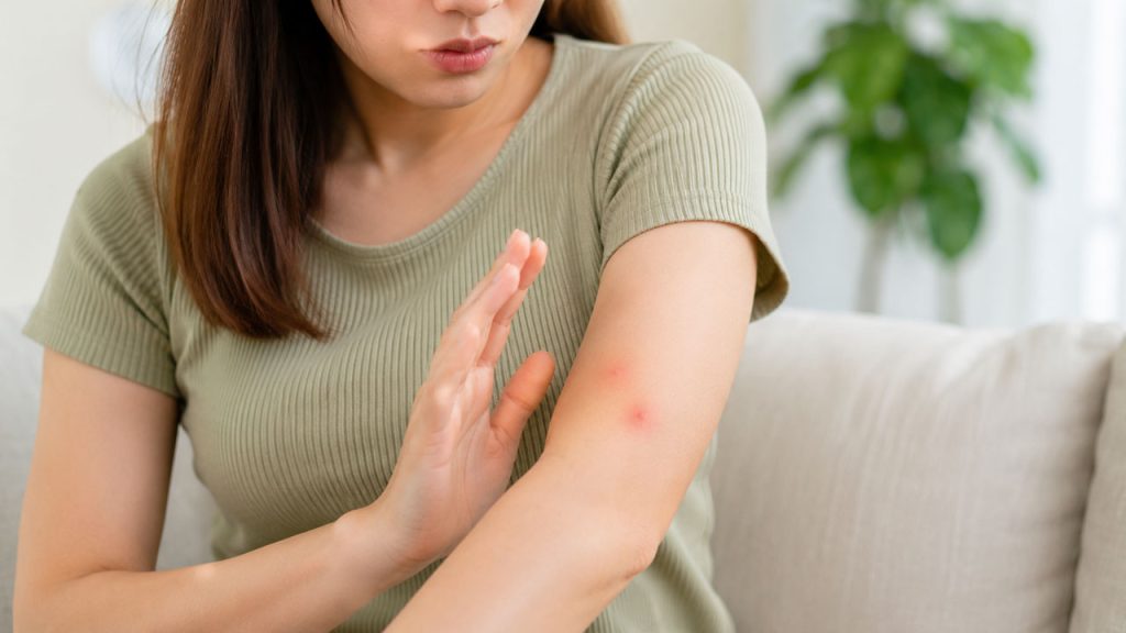 Tránh gãi liên tục để hạn chế tổn thương da do muỗi đốt