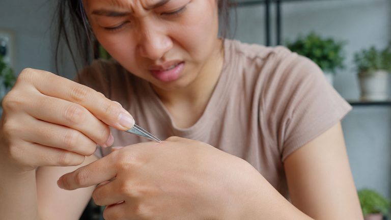 8 Mẹo Lấy Dằm Nhỏ Ra Khỏi Tay Dễ Dàng, An Toàn Và Ít Đau