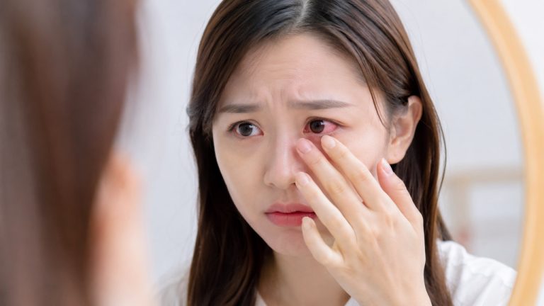 Mẹo trị đau mắt đỏ giúp giảm khó chịu và chăm sóc mắt đúng cách